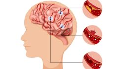 Pentingnya Sistem Rujukan dalam Penanganan Pasien Stroke di Indonesia Pentingnya Sistem Rujukan dalam Penanganan Pasien Stroke di Indonesia