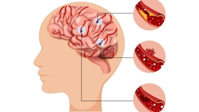 Pentingnya Sistem Rujukan dalam Penanganan Pasien Stroke di Indonesia Pentingnya Sistem Rujukan dalam Penanganan Pasien Stroke di Indonesia