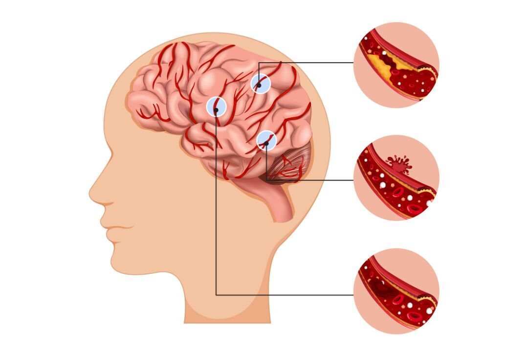Pentingnya Sistem Rujukan dalam Penanganan Pasien Stroke di Indonesia
